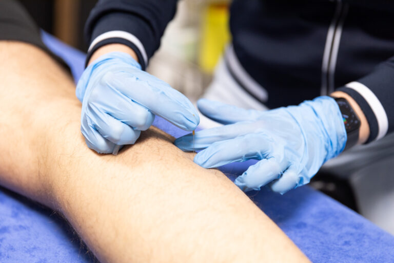 Dry Needling fysiotherapie